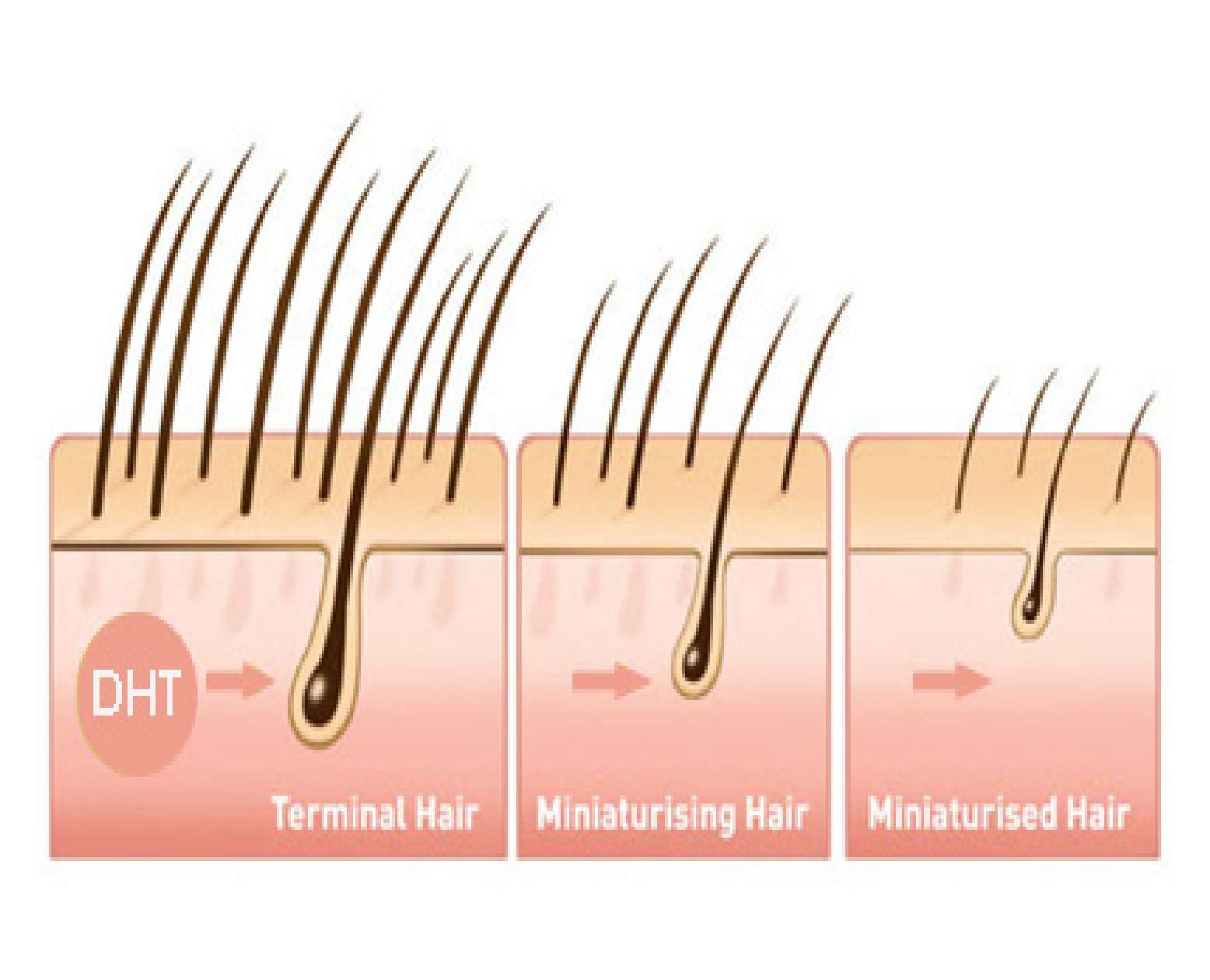 DHT and hair loss