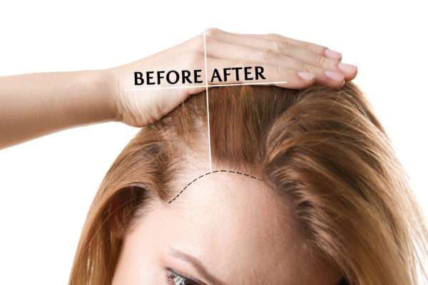 Hair Restoration Program